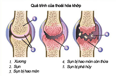 Khi các khớp “lên tiếng”